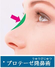 プロテーゼ隆鼻術